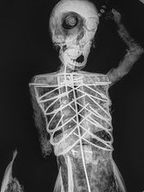 Рентген русалки показал, что внутри у нее проволока