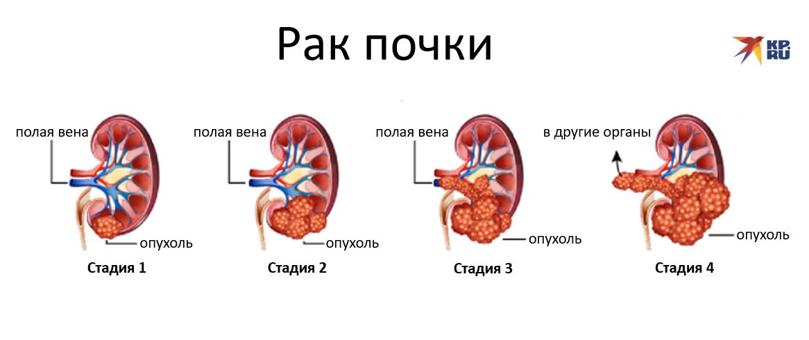 Рак почки: первые симптомы и признаки, обследования на ранних стадиях